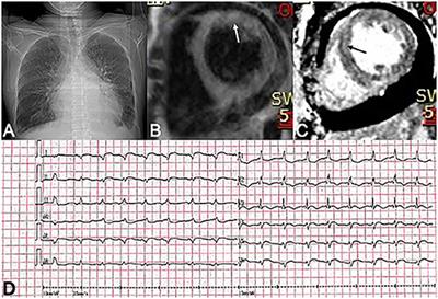 Progressive Heart Failure and Death as the Initial Manifestation of NK/T-Cell Lymphoma: A Case Report and Literature Review